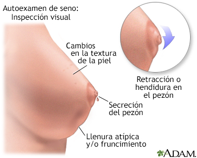 Autoexamen de seno