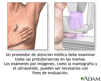 Protuberancias mamarias