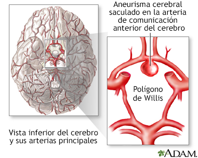 Aneurisma cerebral