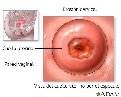 Erosión cervical