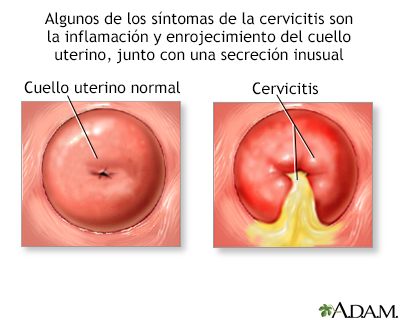 Cervicitis