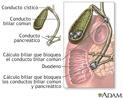 Coledocolitiasis