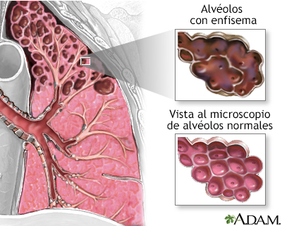 Enfisema