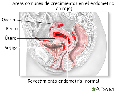 Endometriosis