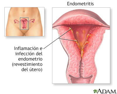 Endometritis