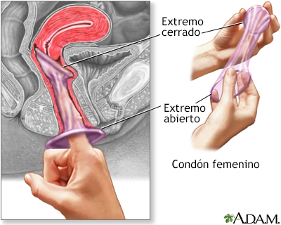 El condón femenino