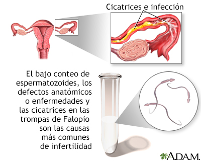 Infertilidad primaria