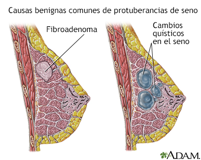 Causas de las protuberancias de seno