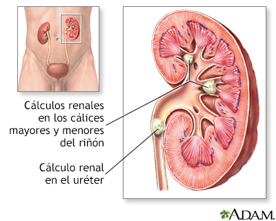 Nefrolitiasis