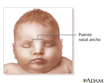 Puente nasal ancho