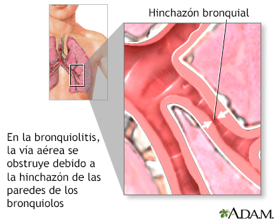 Bronquiolitis