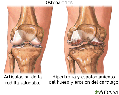 Osteoartritis