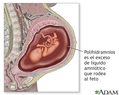 Polihidramnios