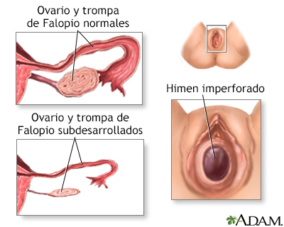 Amenorrea primaria