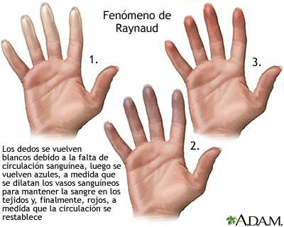 Fenómeno de Raynaud