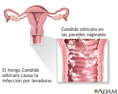 Infecciones por levaduras