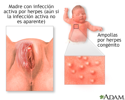 Herpes congénito