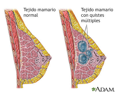 Enfermedad fibroquística de las mamas