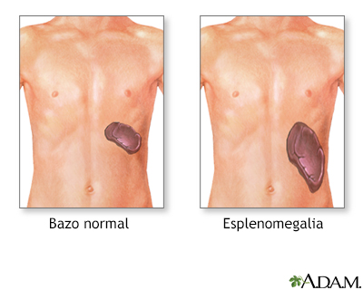 Esplenomegalia