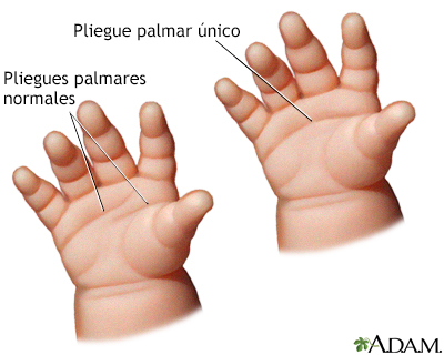 Pliegue palmar único