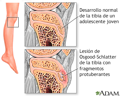 Dolor de pierna (lesión de Osgood-Schlatter)