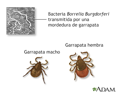 Enfermedad de Lyme terciaria