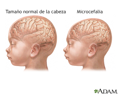 Microcefalia