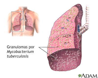 Tuberculosis miliar