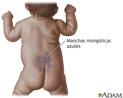 Manchas mongólicas