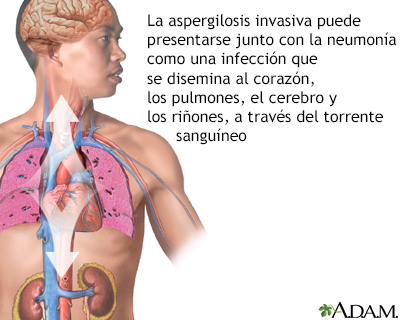 Aspergilosis pulmonar