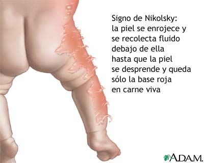 Signo de Nikolsky