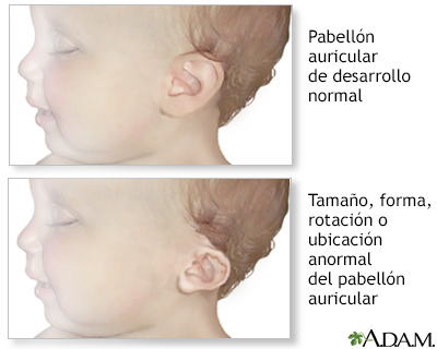 Anomalías de la oreja