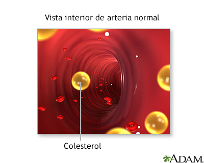 Bloqueo en la arteria carótida interna