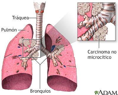 Carcinoma no microcítico