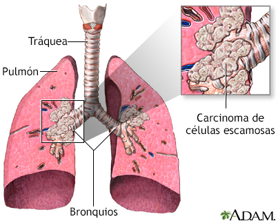 Carcinoma de células escamosas