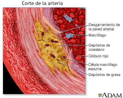 Vista agrandada de la aterosclerosis