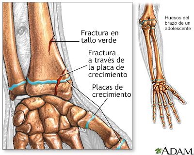 Fracturas a lo largo de una placa de crecimiento