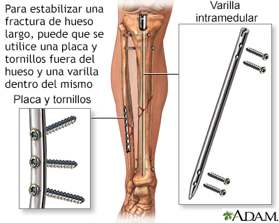 Dispositivos de fijación interna