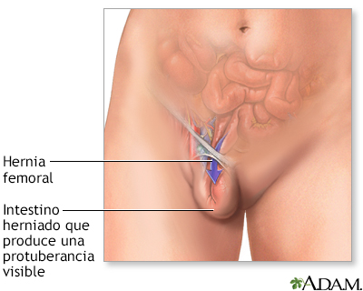 Hernia femoral