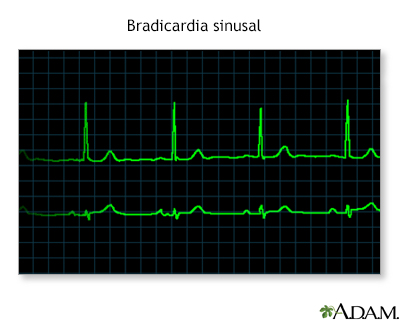 Bradicardia