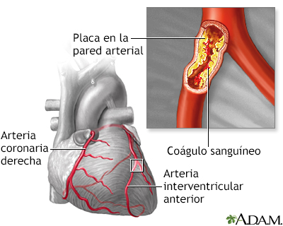 Aterosclerosis