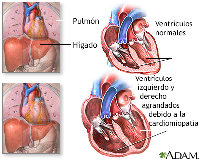 Cardiomiopatía alcohólica