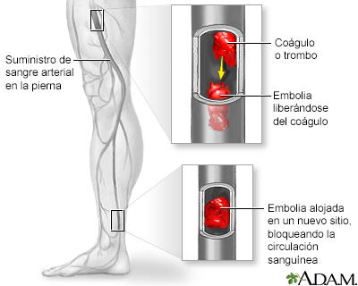 Embolia arterial