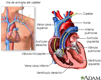 Cateterización de Swan Ganz