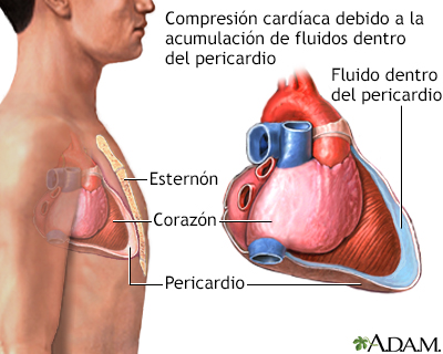 Taponamiento cardíaco