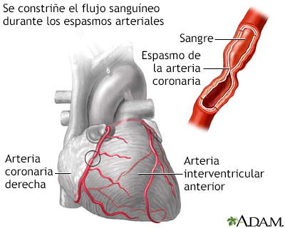 Espasmo de la arteria coronaria