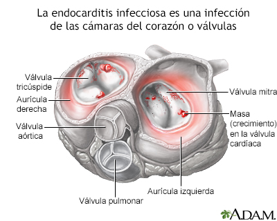 Endocarditis infecciosa