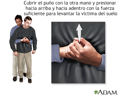 Maniobra de Heimlich en el adulto