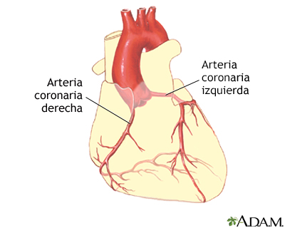 Angioplastia coronaria con balón - Serie