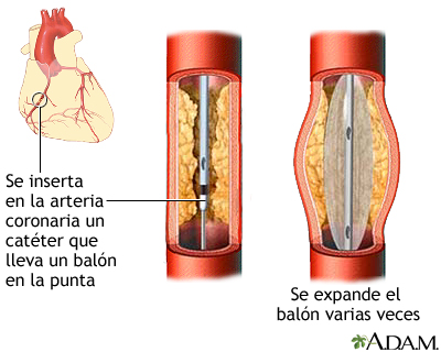 Procedimiento (tercera parte)